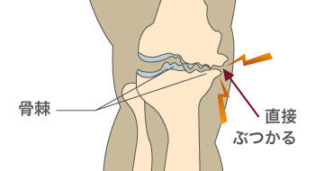 変形性膝関節症（進行期）